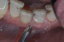 Fogelszíneződések eltávolítása Air-brush módszerrel