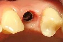 Camlog implantációs rendszer műgyökér