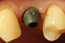 Camlog implantációs rendszer felépítmény