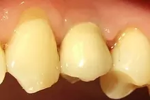 Camlog implantációs rendszer végleges pótlás