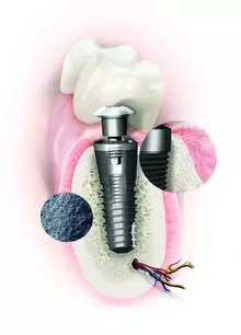 Endure implantációs rendszerek