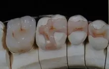 inlay a gipszmintán