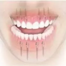 MDI implantációs rendszer